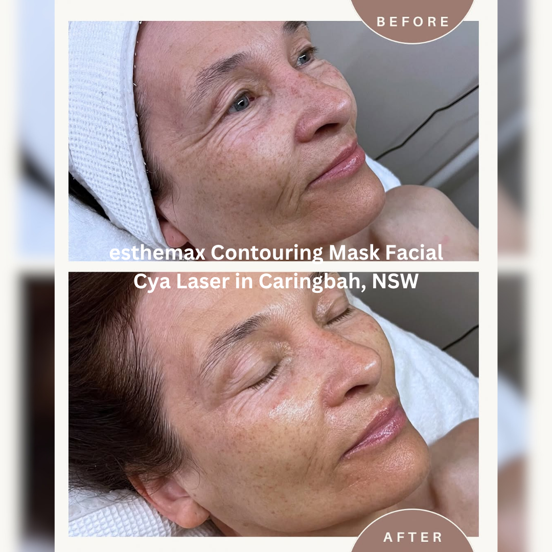 Cya Laser – Caringbah, NSW Before and after esthemax Contouring Mask facial showing brighter, smoother skin with refined texture and a hydrated, radiant finish.
