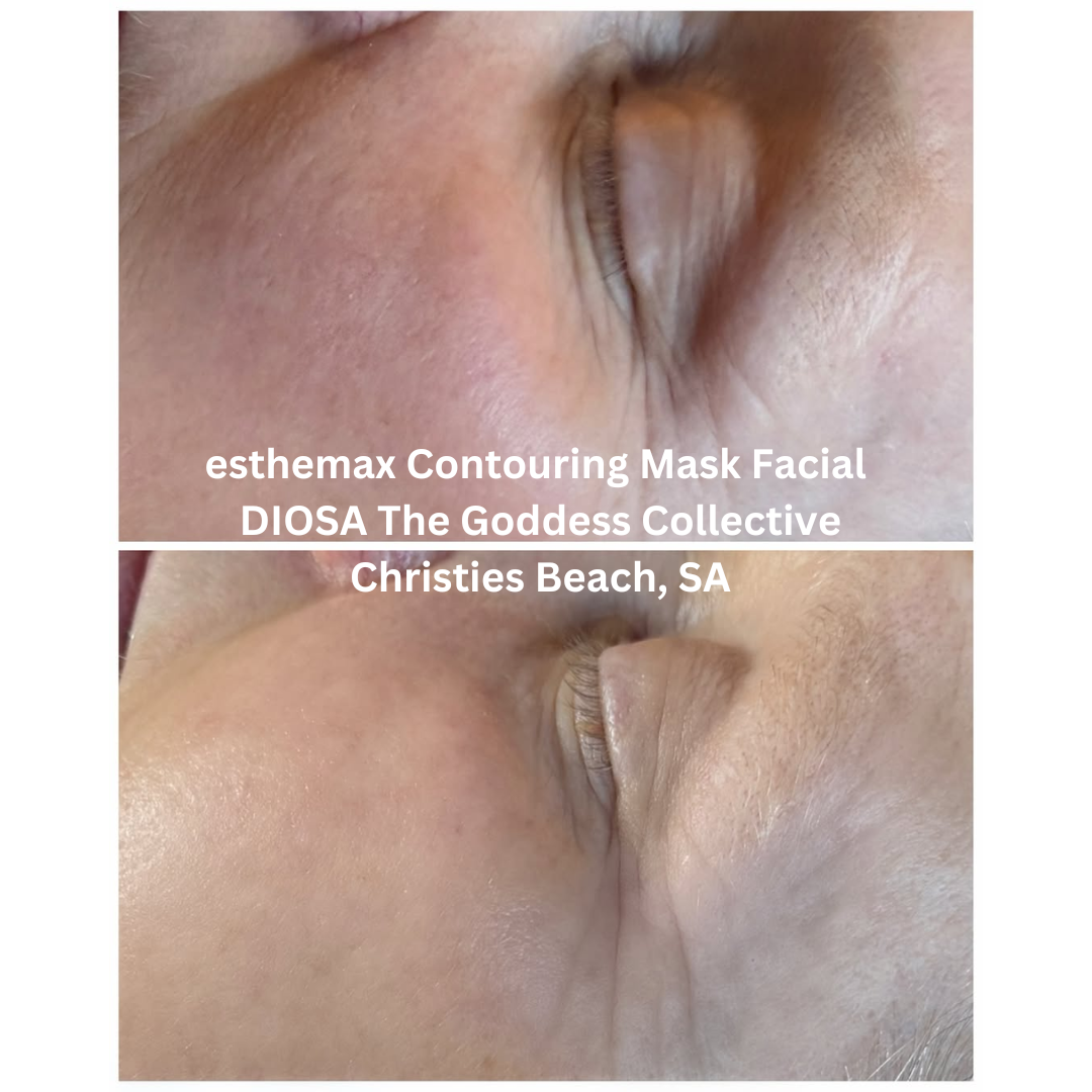 Close-up before and after images of the eye area following an esthemax Contouring Mask Facial at DIOSA The Goddess Collective in Christies Beach, South Australia. The after image shows smoother-looking skin with improved hydration and a softer appearance of fine lines.