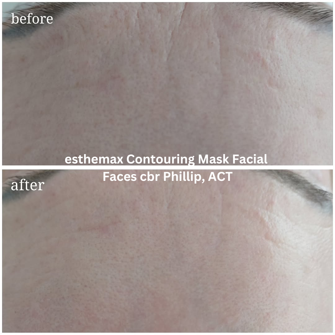 Before and after close-up images of the forehead following an esthemax® Contouring Mask Facial at Faces cbr in Phillip, ACT. The after image shows smoother-looking skin with improved hydration and a more even surface appearance across the forehead.
