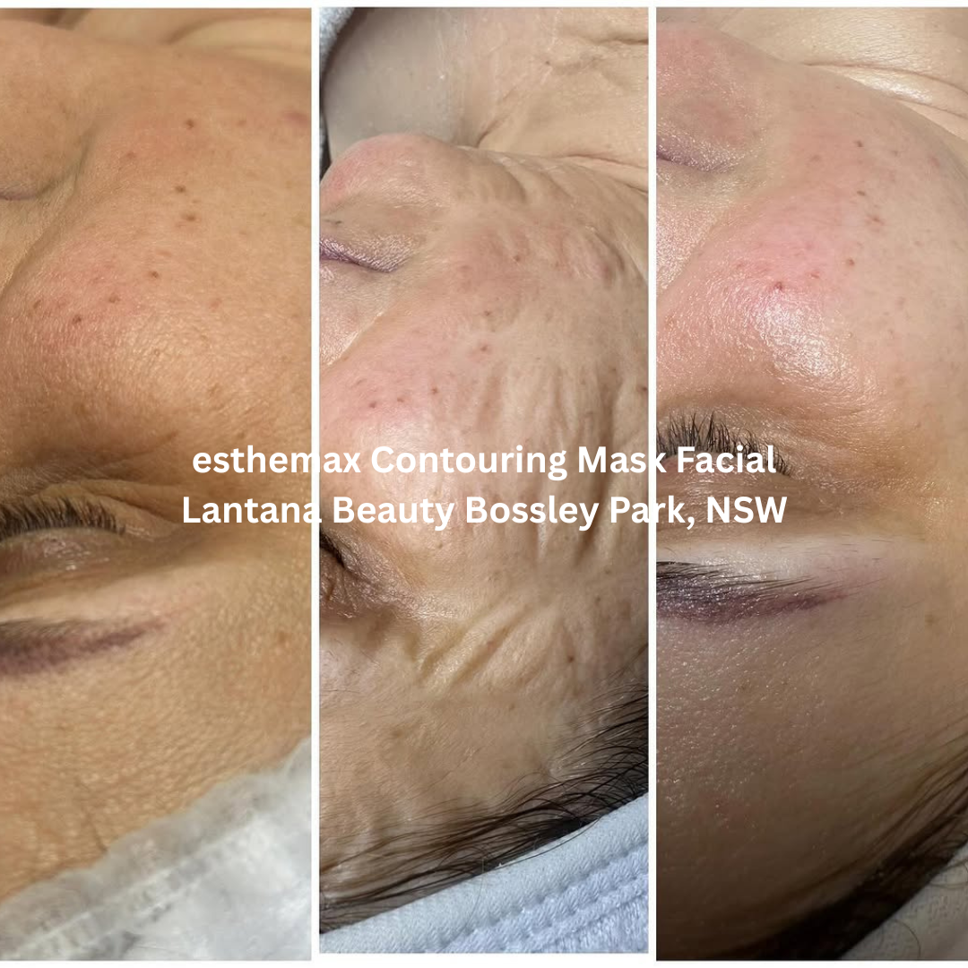 Before and after images following an esthemax Contouring Mask Facial at Lantana Beauty in Bossley Park, New South Wales. The after image shows visibly softened expression lines, improved skin smoothness, and a firmer, more hydrated appearance.