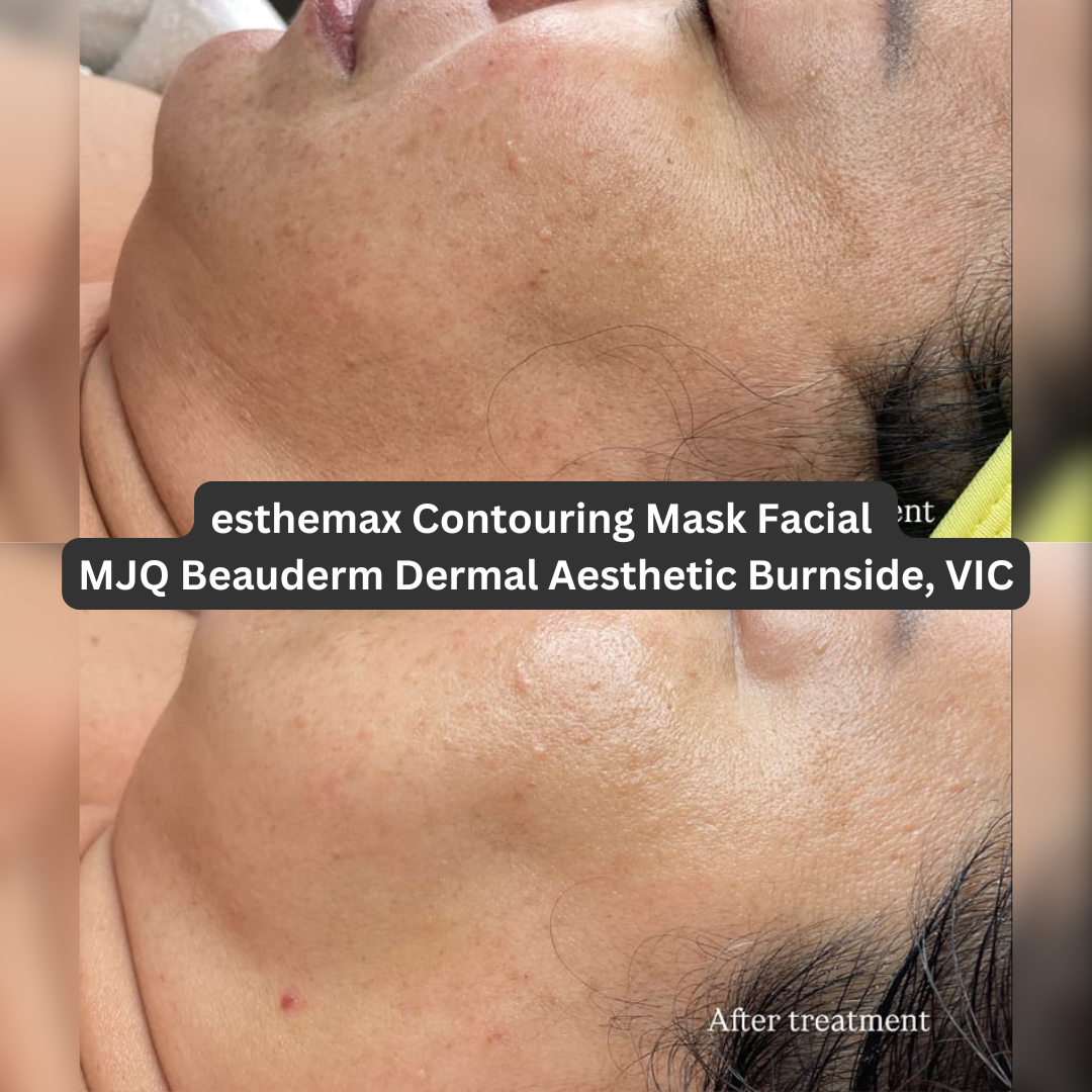 Before and after side-profile images following an esthemax® Contouring Mask Facial at MJQ Beauderm Dermal Aesthetic in Burnside, Victoria. The after-treatment image shows visibly smoother-looking skin with improved hydration and a more even, radiant surface across the cheek and jawline.