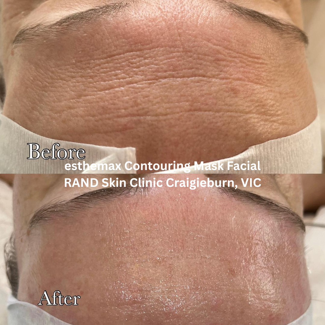 Before and after esthemax Contouring Mask Facial at RAND Skin Clinic, Craigieburn VIC, showing visibly smoother forehead lines, refined skin texture, improved hydration, and a radiant post-treatment glow.