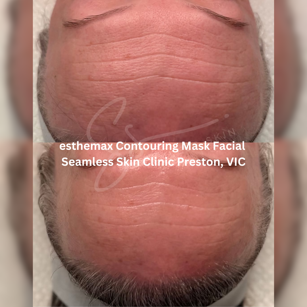 Seamless Skin Clinic – Preston, VIC
Forehead before and after esthemax Contouring Mask facial showing visibly softened fine lines, smoother texture, and improved skin hydration.
