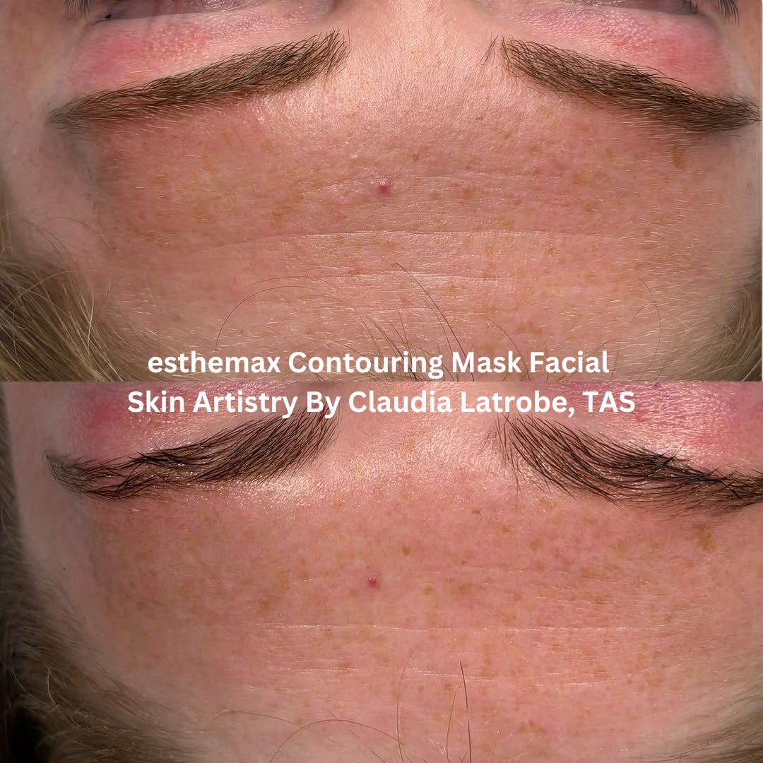Before and after close-up images of the forehead following an esthemax® Contouring Mask Facial at Skin Artistry By Claudia in Latrobe, Tasmania. The after image shows refined skin texture with improved hydration and a softer overall appearance.