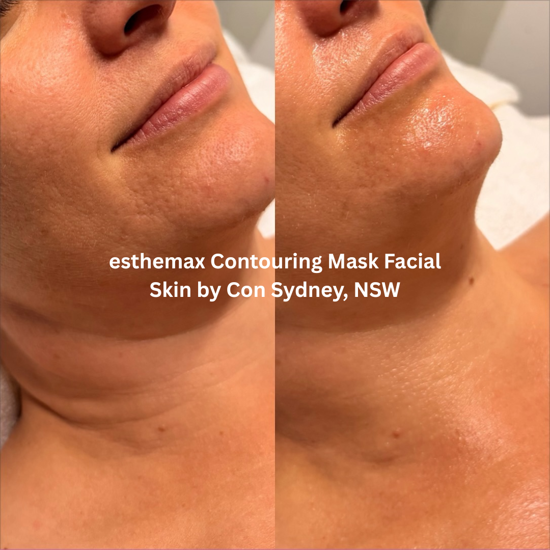 Before and after esthemax Contouring Mask Facial at Skin by Con, Sydney NSW, showing smoother-looking chin texture, increased hydration and a dewy finish.
