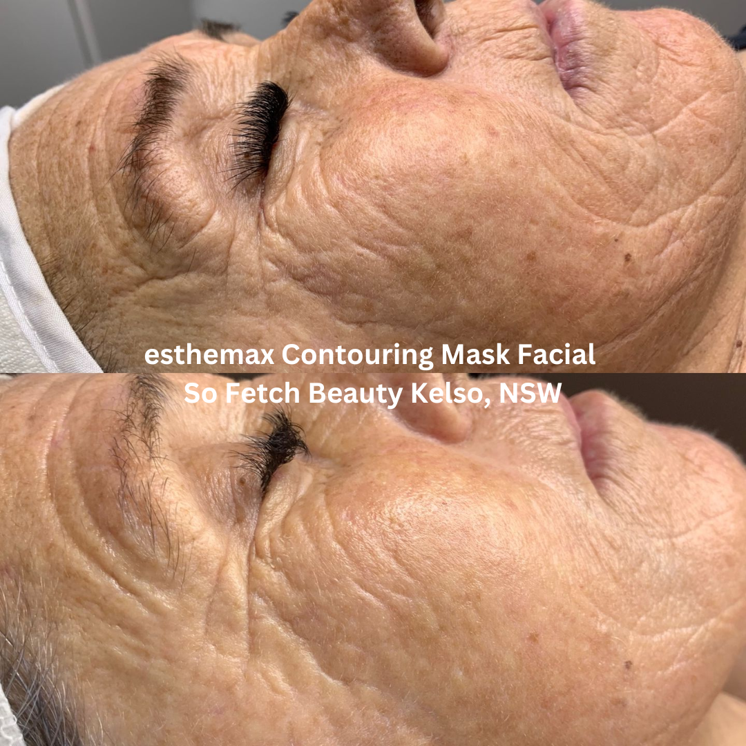 Before and after images of the face following an esthemax Contouring Mask Facial at So Fetch Beauty in Kelso, New South Wales. The after image shows visibly nourished skin with enhanced radiance, softened appearance of fine lines, and a refreshed, healthy-looking glow.