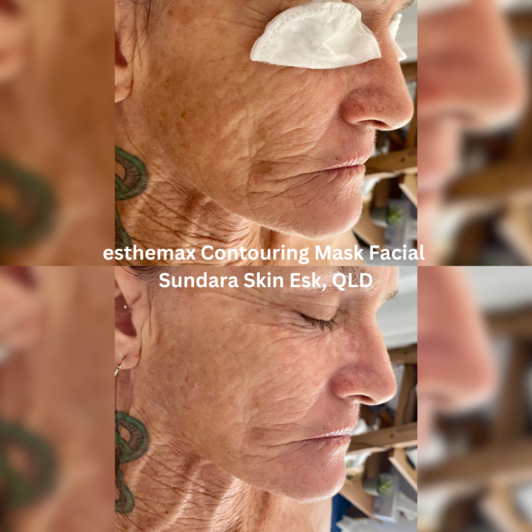 Side-profile before and after results of an esthemax® Contouring Mask Facial at Sundara Skin in Esk, Queensland. Post-treatment skin shows improved firmness, smoother texture, and a more lifted, sculpted appearance.