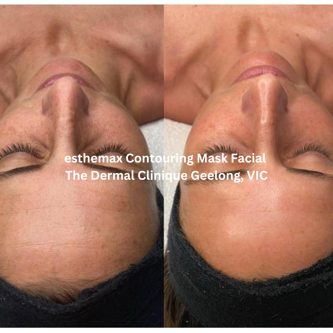 Before and after front-facing images following an esthemax® Contouring Mask Facial at The Dermal Clinique in Geelong, Victoria. The after image shows visibly smoother-looking skin with enhanced hydration and a more even, radiant complexion.