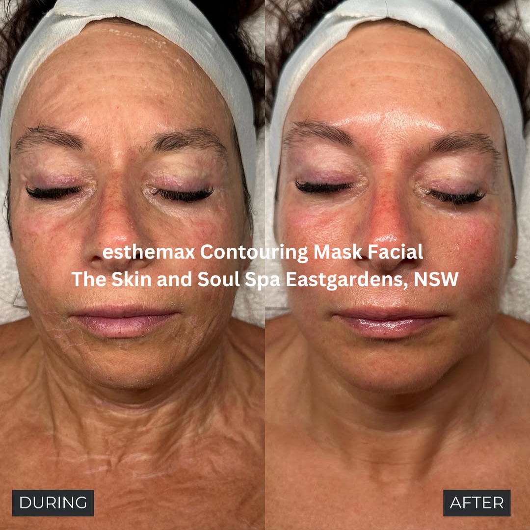 During and after an esthemax Contouring Mask Facial at The Skin and Soul Spa in Eastgardens, NSW. The after image shows visibly calmer, more even-toned skin with a hydrated, refined surface and reduced redness.