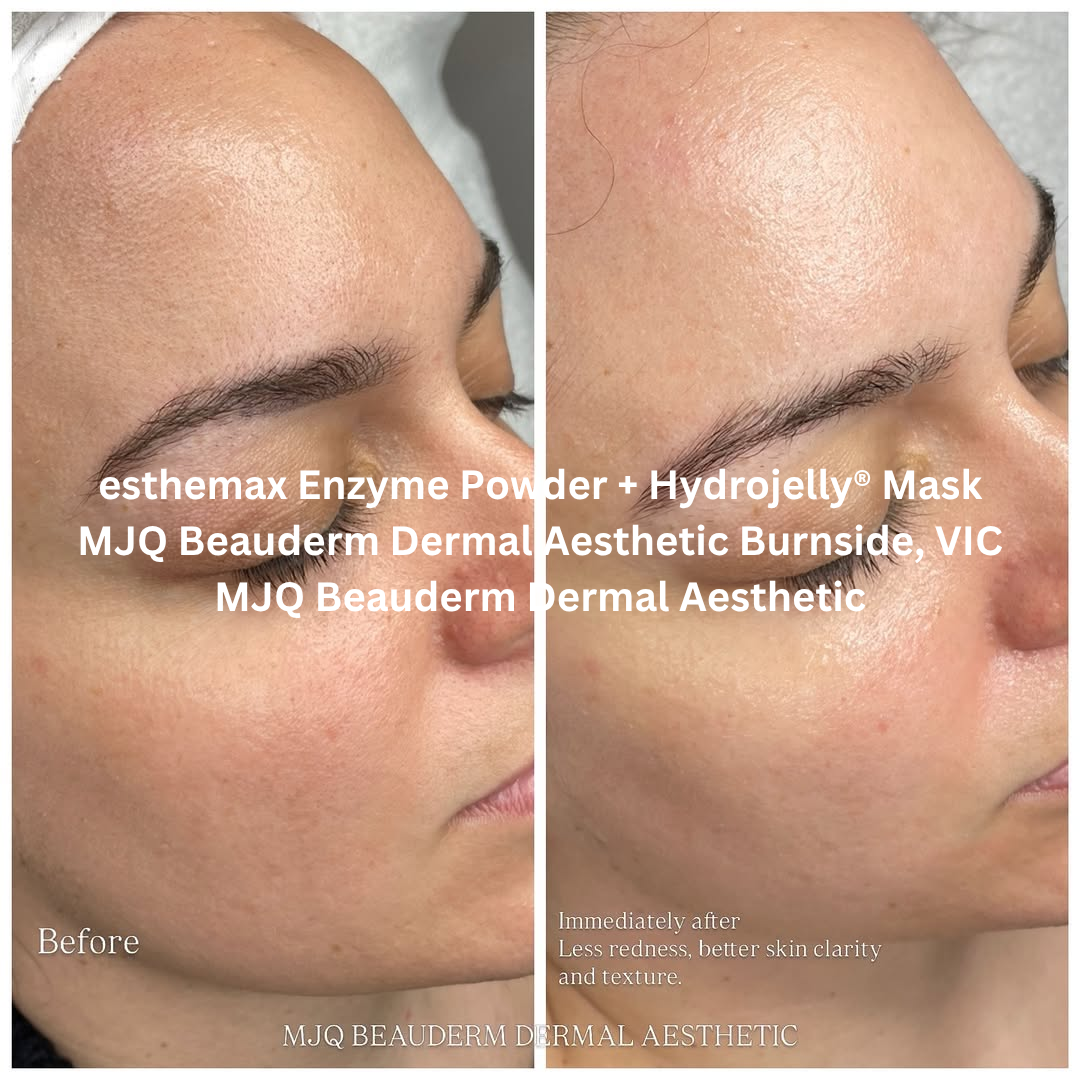Before and after images of the skin following an esthemax Enzyme Powder and Hydrojelly® Mask treatment at MJQ Beauderm Dermal Aesthetic in Burnside, Victoria. The after image shows a brighter complexion with smoother texture, reduced redness, and a more even skin tone.