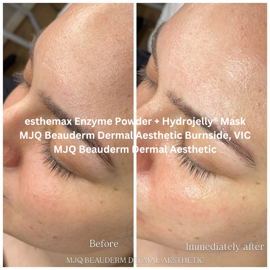 Before and after images of the skin following an esthemax Enzyme Powder and Hydrojelly® Mask treatment at MJQ Beauderm Dermal Aesthetic in Burnside, Victoria. The after image shows improved skin clarity, a more refined surface, and a visibly calmer, more balanced complexion.