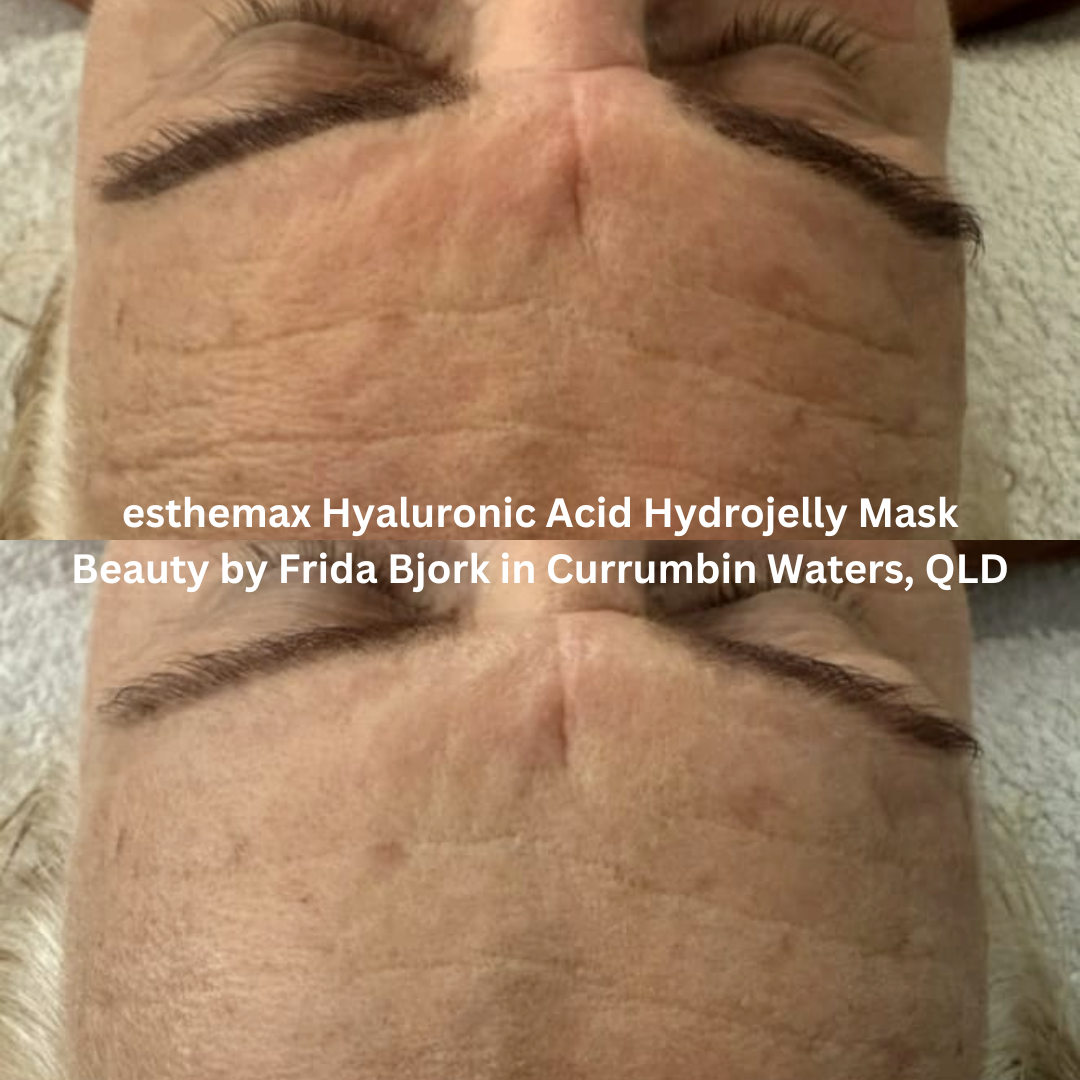 Before and after close-up images of the forehead following a facial treatment using the esthemax® Hyaluronic Acid Hydrojelly® Mask at Beauty by Frida Bjork in Currumbin Waters, Queensland. The after image shows smoother-looking skin with improved hydration and a more refined surface appearance.