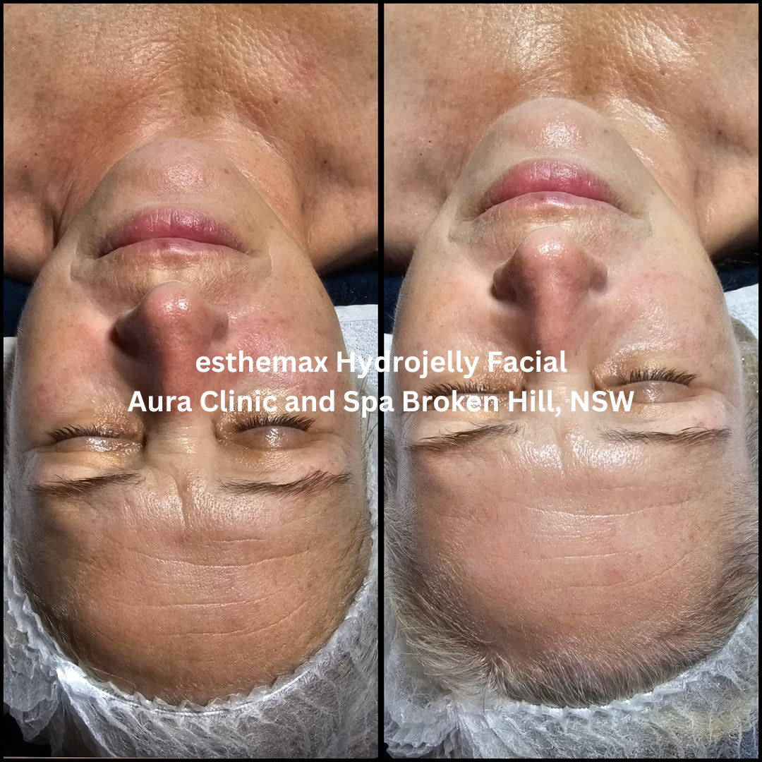 Before and after images of the forehead and upper face following an esthemax Hydrojelly Facial at Aura Clinic and Spa in Broken Hill, New South Wales. The after image shows smoother-looking skin, improved hydration, and a more radiant complexion.