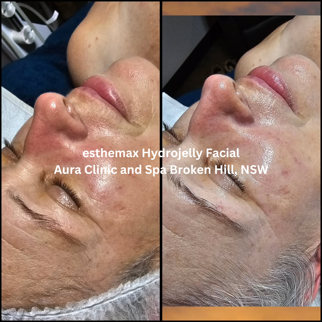 Before and after images of the cheek area following an esthemax Hydrojelly Facial at Aura Clinic and Spa in Broken Hill, New South Wales. The after image shows enhanced hydration, increased radiance, and smoother-looking skin with a healthy glow.