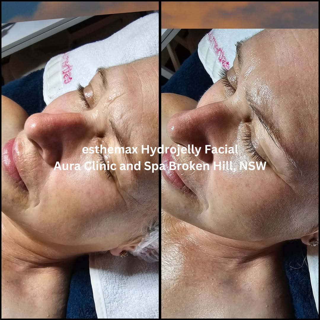 Before and after images of the side profile following an esthemax Hydrojelly Facial at Aura Clinic and Spa in Broken Hill, New South Wales. The after image shows brighter, more hydrated skin with enhanced luminosity and a dewy finish.