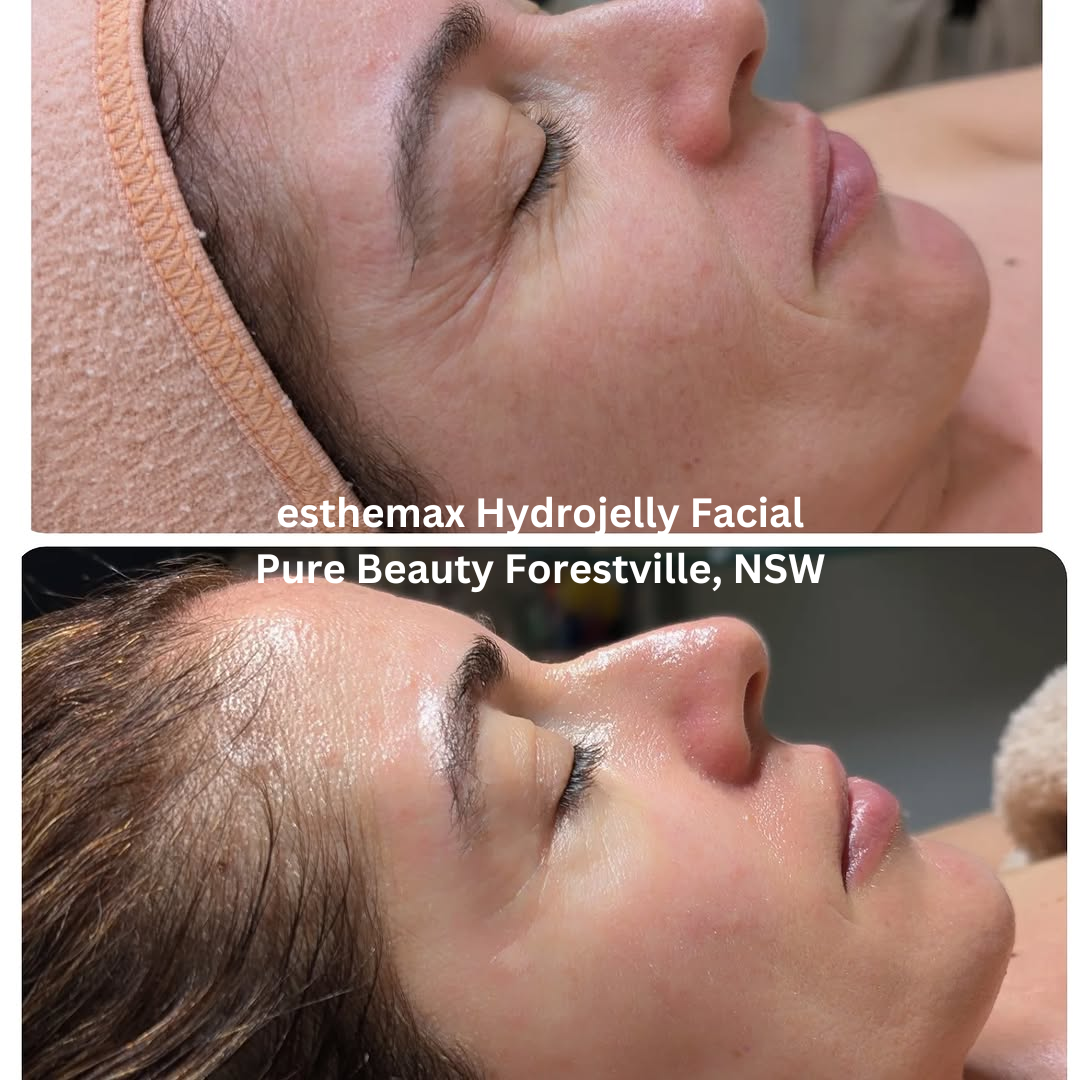 Pure Beauty – Forestville, NSW
Before and after esthemax Hydrojelly facial showing deeply hydrated, dewy skin with enhanced glow and smoother overall texture.