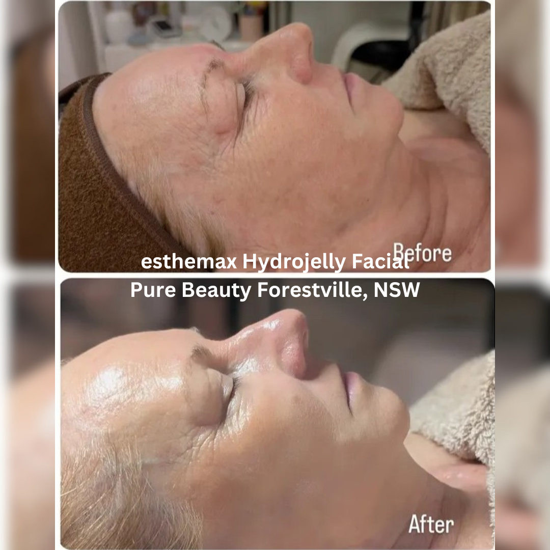 Before and after images of the face following an esthemax Hydrojelly Facial at Pure Beauty in Forestville, New South Wales. The after image shows a more hydrated, radiant complexion with smoother-looking skin and enhanced glow.