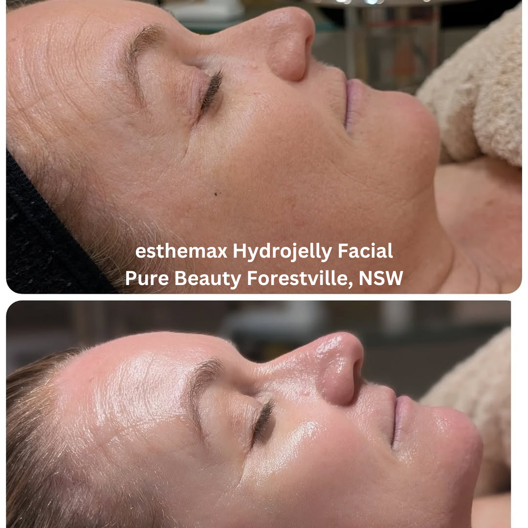 Before and after images of the skin following an esthemax Hydrojelly Facial at Pure Beauty in Forestville, New South Wales. The after image shows increased luminosity, improved hydration, and a more even, dewy finish.