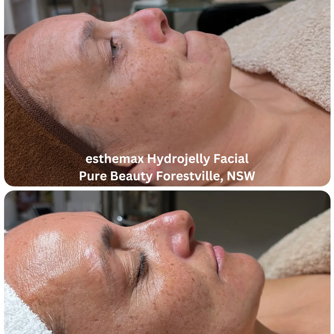 Before and after images of the face following an esthemax Hydrojelly Facial at Pure Beauty in Forestville, New South Wales. The after image shows smoother-looking skin, a more even tone, and a healthy, hydrated glow.