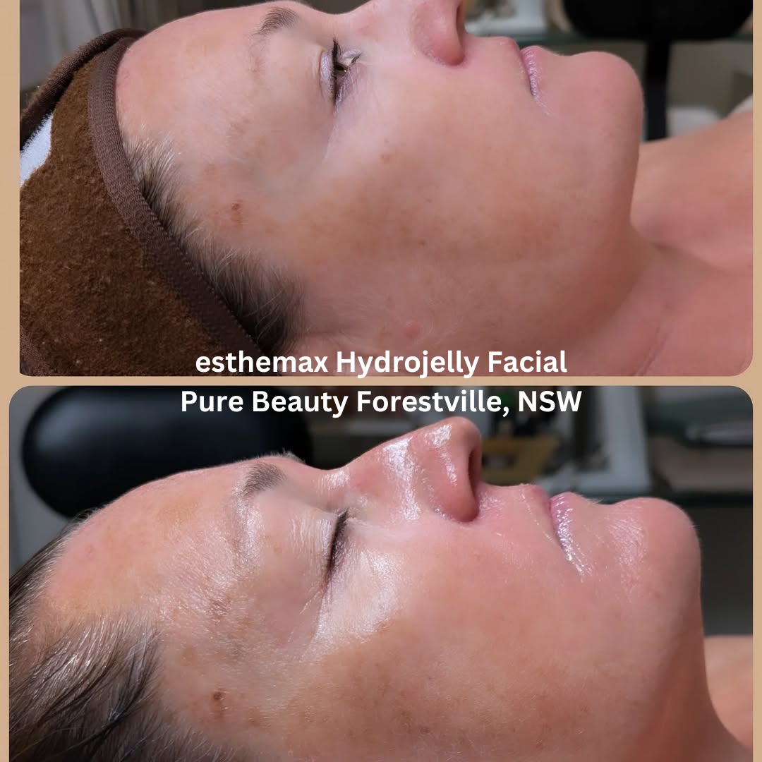 Before and after images of the face following an esthemax Hydrojelly Facial at Pure Beauty in Forestville, New South Wales. The after image shows a more hydrated, radiant complexion with visibly smoother-looking skin and enhanced luminosity.