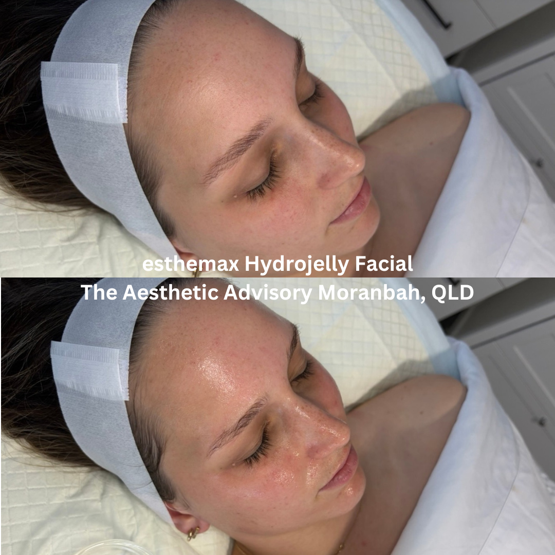 Before and after esthemax Hydrojelly Facial, showing enhanced hydration, luminous skin, and a fresh, dewy complexion.