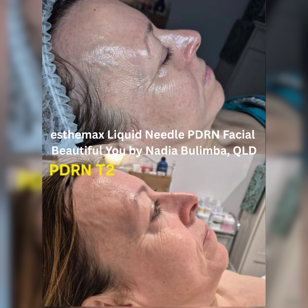 Side-profile before and after images of an esthemax® Liquid Needle PDRN Facial at Beautiful You by Nadia in Bulimba, Queensland. The after image shows visibly hydrated skin with improved smoothness and a healthier overall glow.