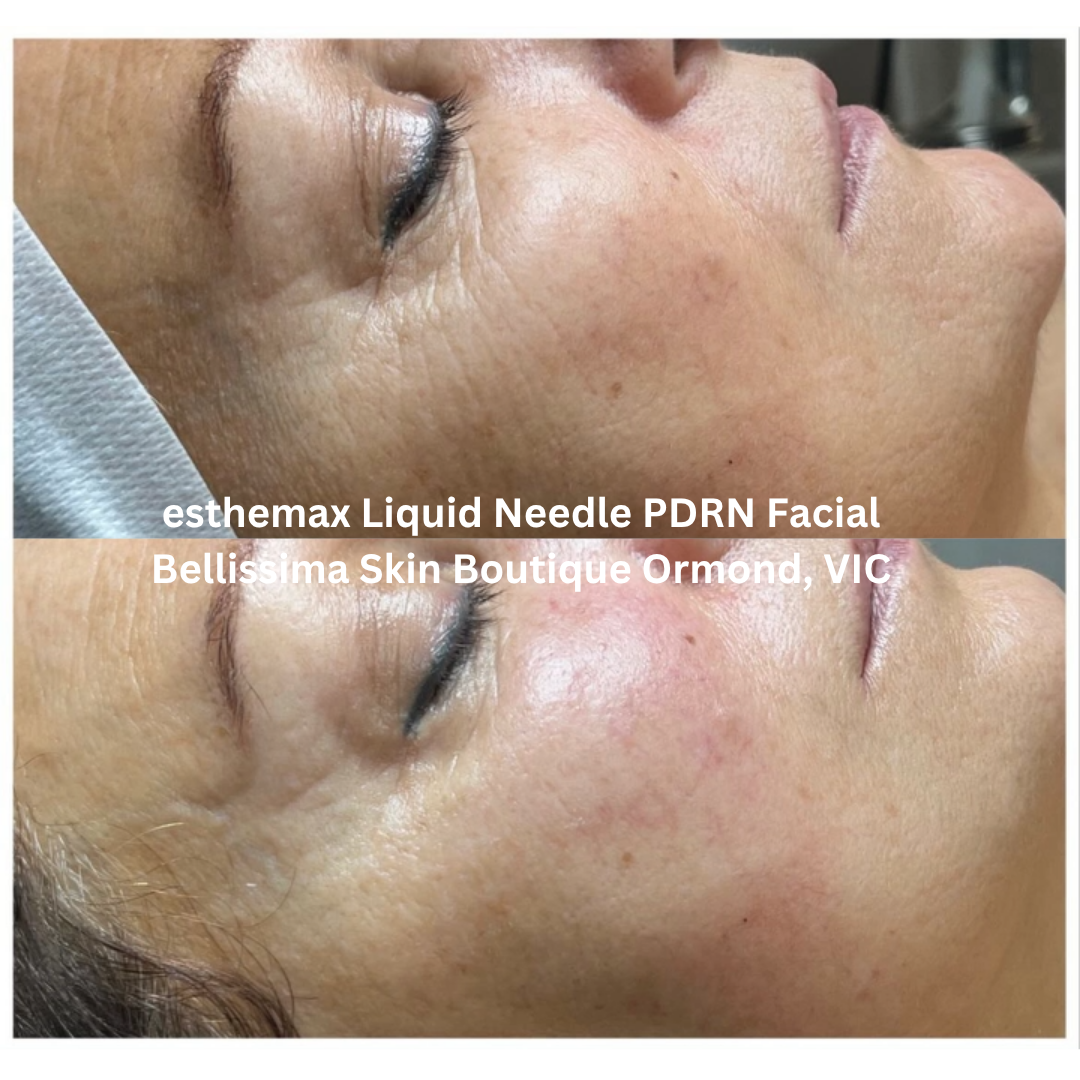 Before and after images of the cheek area following an esthemax Liquid Needle PDRN Facial at Bellissima Skin Boutique in Ormond, Victoria. The after image shows brighter, more hydrated skin with enhanced glow and smoother overall texture.