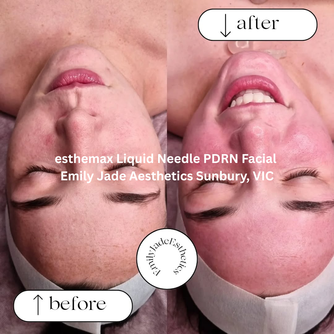 Before and after results of an esthemax® Liquid Needle PDRN Facial at Emily Jade Aesthetics in Sunbury, Victoria. The skin looks brighter, refined, and visibly smoother, showing signs of post-treatment regeneration and glow.