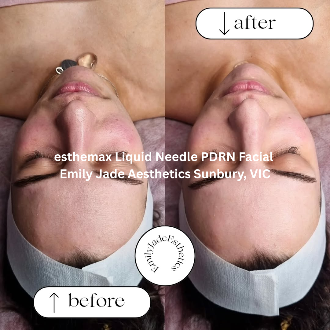 Emily Jade Aesthetics – Sunbury, VIC Before and after esthemax Liquid Needle PDRN facial showing calmer skin, reduced redness, and a smoother, more even complexion with a hydrated glow.
