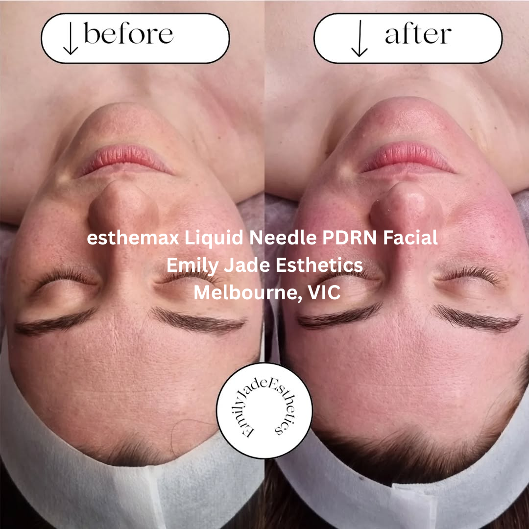 Before and after images of an esthemax® Liquid Needle PDRN Facial at Emily Jade Esthetics in Melbourne, Victoria. The after image shows a more even-looking complexion with visible hydration and refined skin texture.
