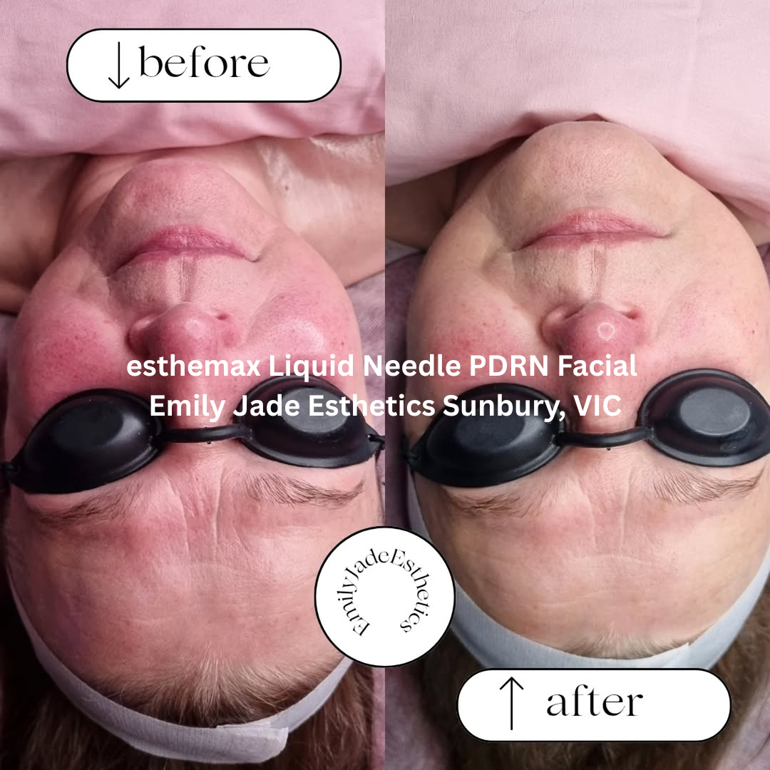 Before and after images of the face following an esthemax Liquid Needle PDRN Facial at Emily Jade Esthetics in Sunbury, Victoria. The after image shows reduced redness, a calmer complexion, and smoother-looking skin with improved overall clarity.