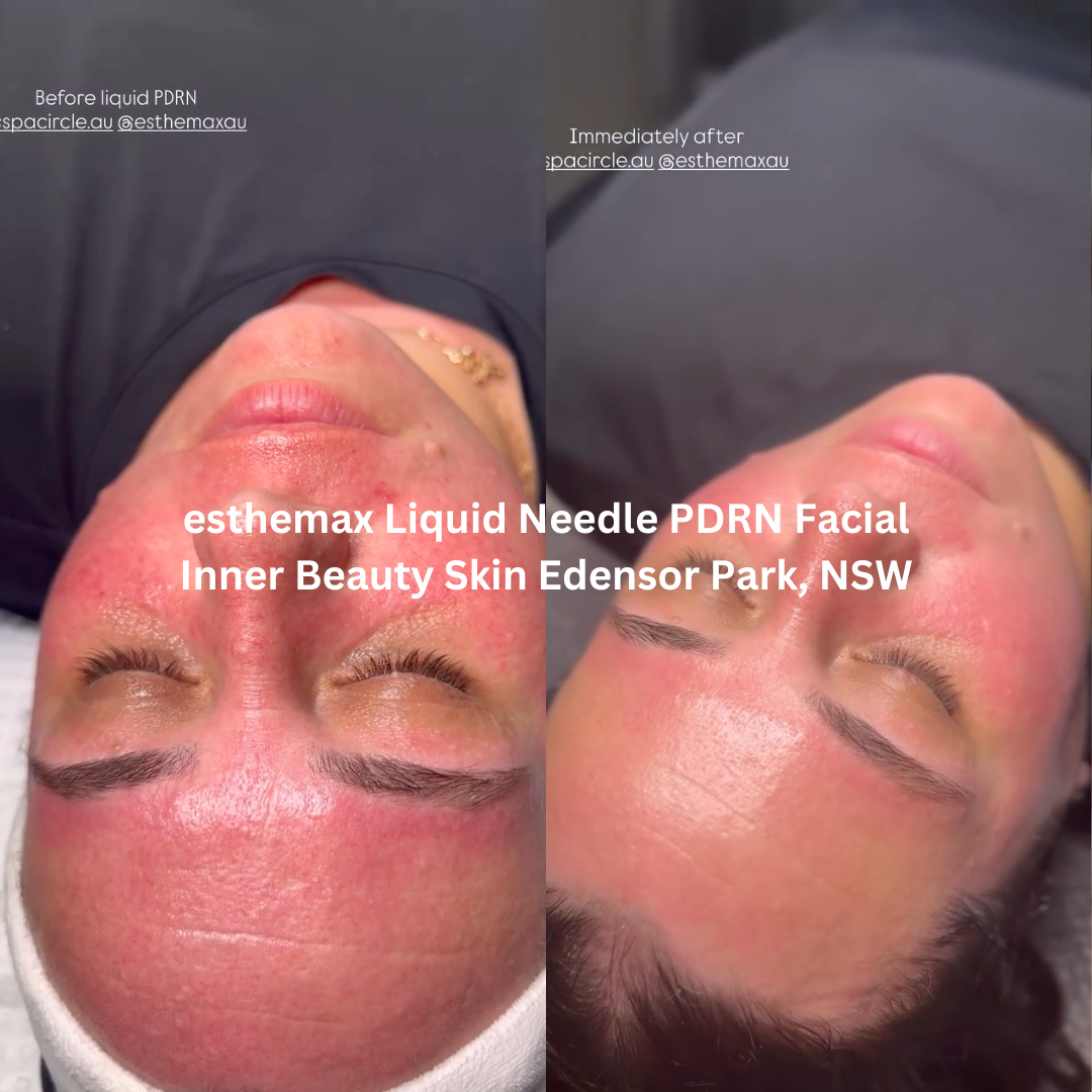 Before and after front-facing images following an esthemax® Liquid Needle PDRN Facial at Inner Beauty Skin in Edensor Park, New South Wales. The after image shows visibly hydrated skin with improved glow and a smoother, more luminous complexion immediately after treatment.