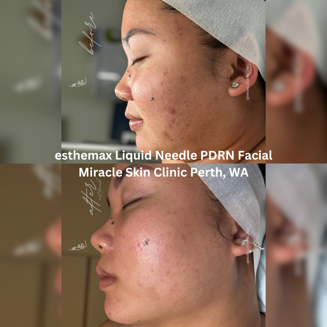 Before and after side-profile images following two sessions of an esthemax® Liquid Needle PDRN Facial at Miracle Skin Clinic in Perth, Western Australia. The after image shows visibly hydrated skin with improved acne scarring texture, less congestion, reduced surface redness, and a more radiant, even-looking complexion.