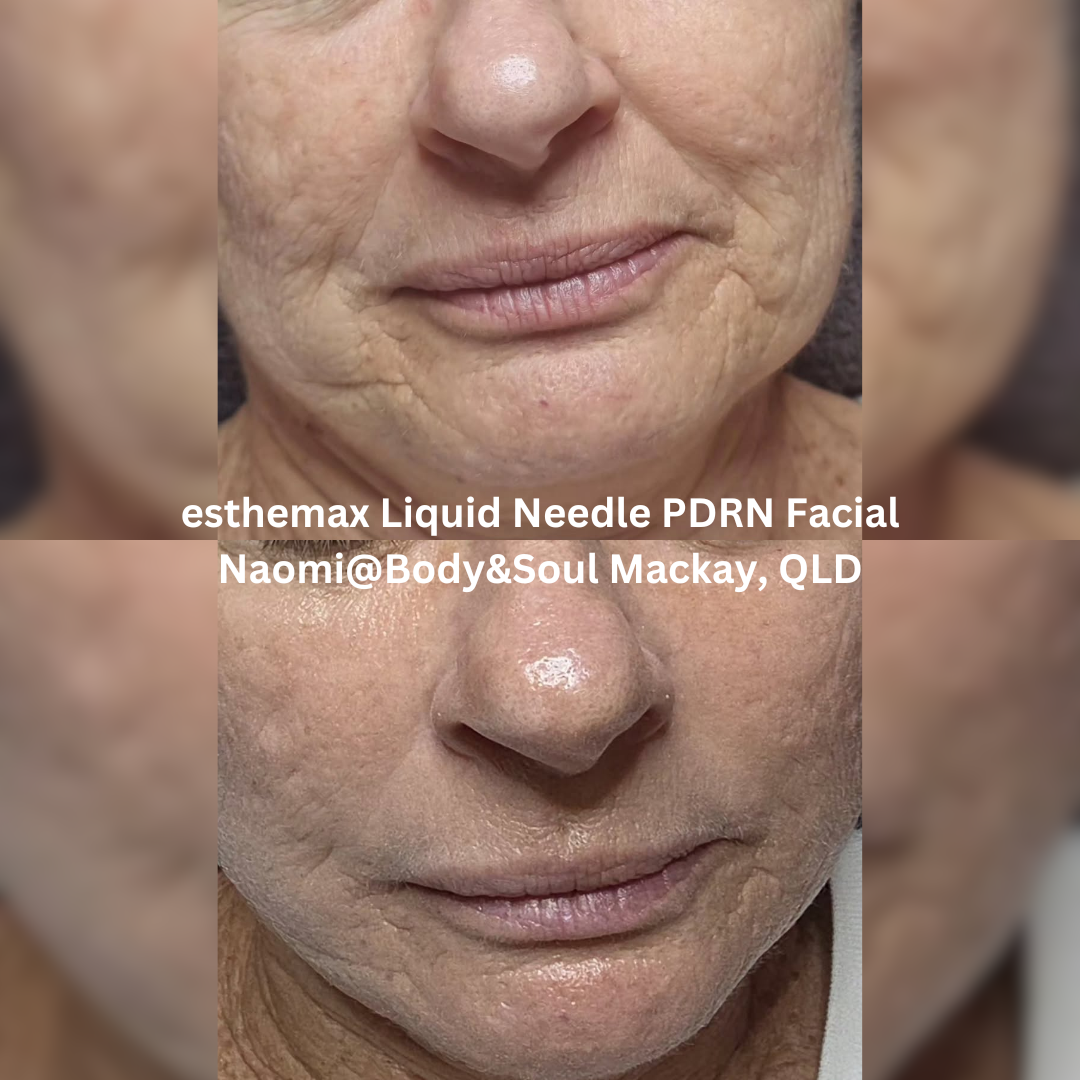 Before and after close-up images of the lower face following three sessions of an esthemax® Liquid Needle PDRN Facial at Naomi @ Body & Soul in Mackay, Queensland. The after image shows visibly improved hydration, a smoother skin surface, and a more even, refreshed appearance around the mouth and chin.