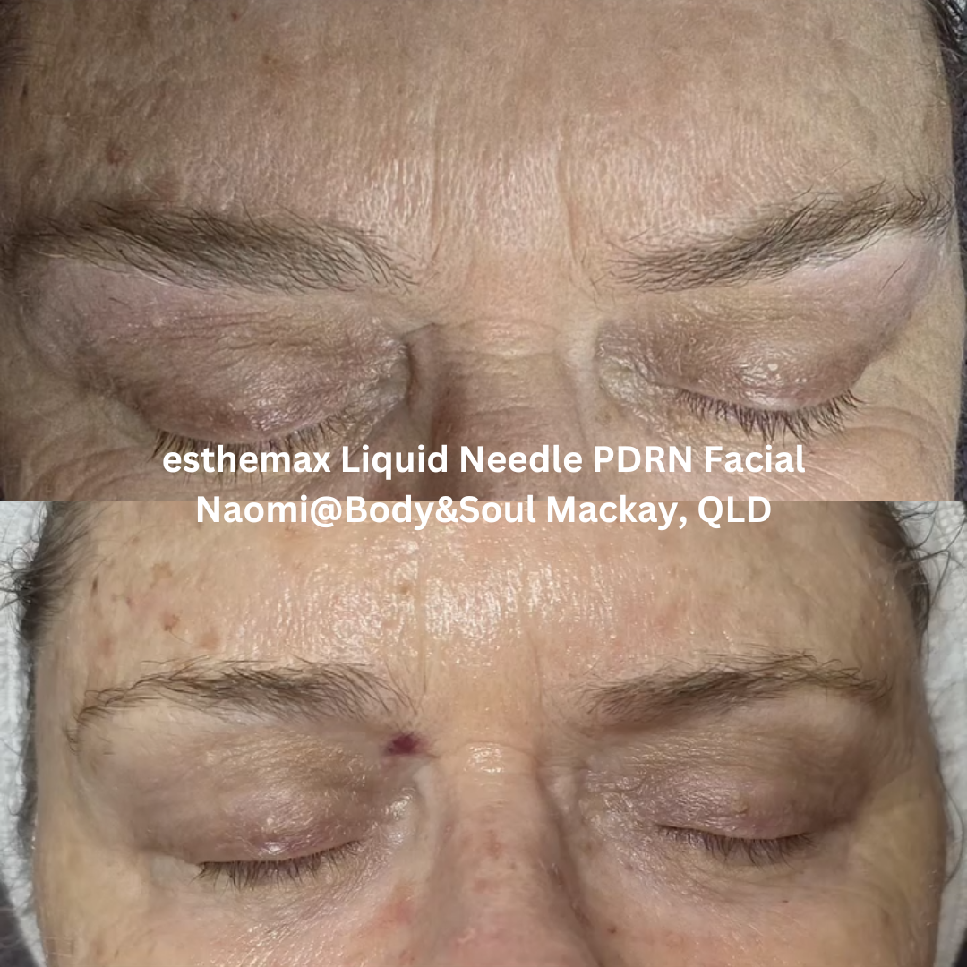 Before and after images of the forehead and eye area following an esthemax Liquid Needle PDRN Facial at Naomi @ Body & Soul in Mackay, Queensland. The after image shows improved skin luminosity, smoother texture, and softened appearance of fine lines.