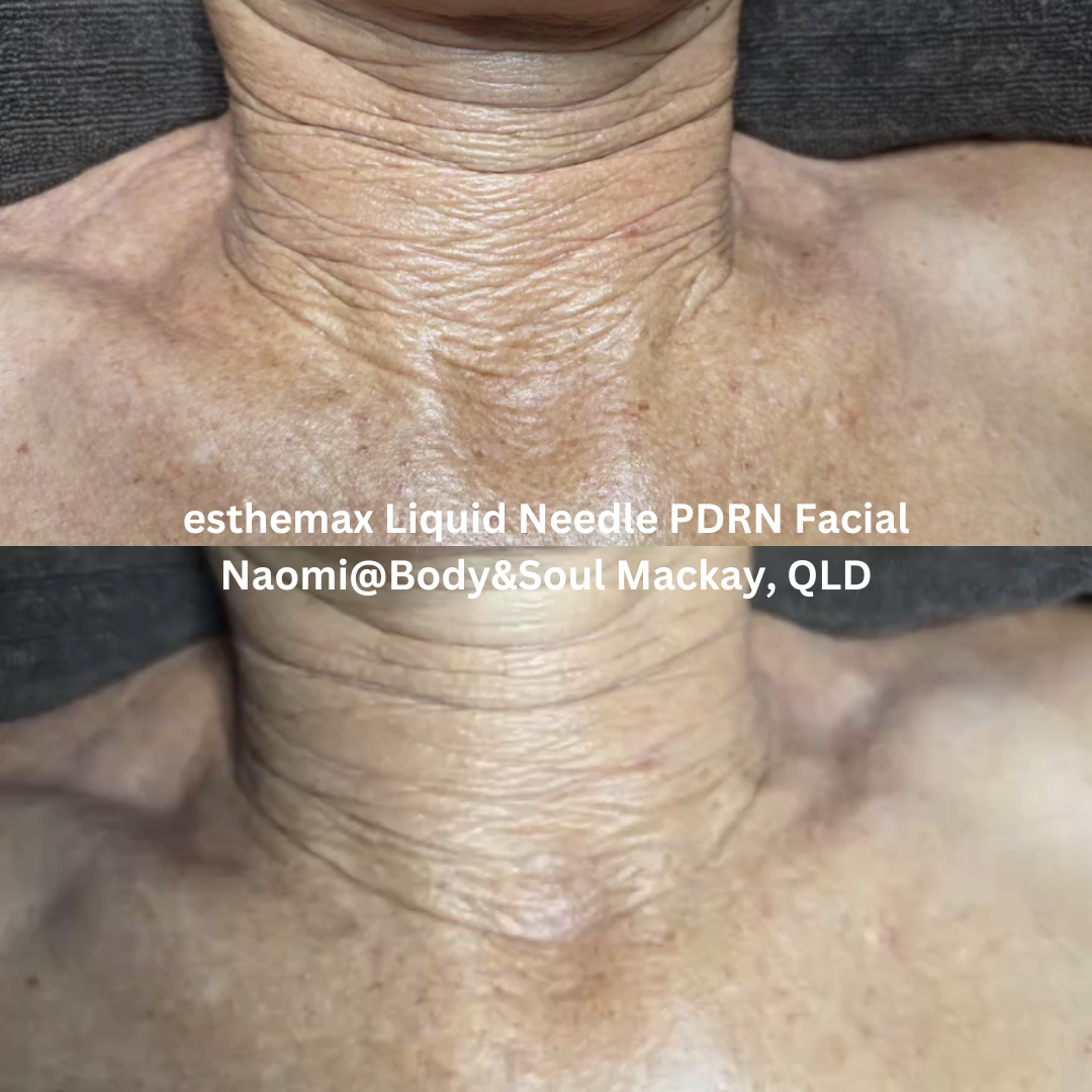 Before and after images of the neck following an esthemax Liquid Needle PDRN Facial at Naomi @ Body & Soul in Mackay, Queensland. The after image shows smoother-looking skin with improved hydration and a softened appearance of crepey texture and fine lines.