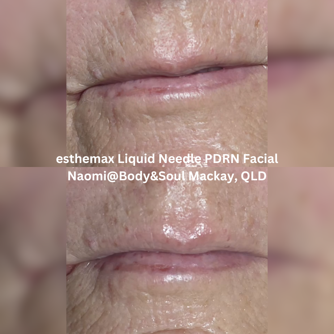 Before and after close-up images of the lip and lower face area following an esthemax Liquid Needle PDRN Facial at Naomi @ Body & Soul in Mackay, Queensland. The after image shows smoother-looking skin with improved hydration and softened appearance of fine lines around the mouth.