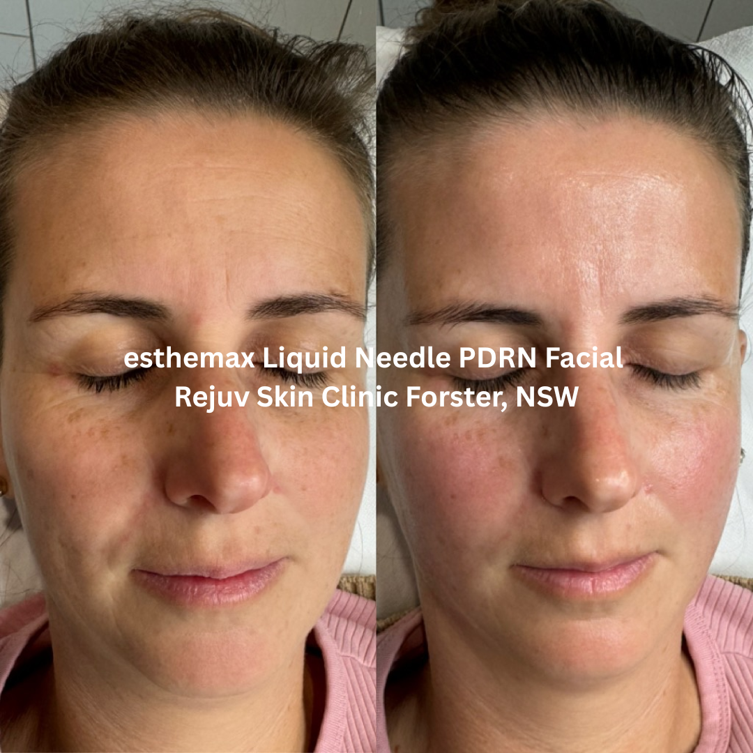 Before and after results of an esthemax® Liquid Needle PDRN Facial at Rejuv Skin Clinic in Forster, New South Wales. The skin shows enhanced hydration and radiance, with a noticeable improvement in smoothness, even tone, and overall luminosity after treatment.