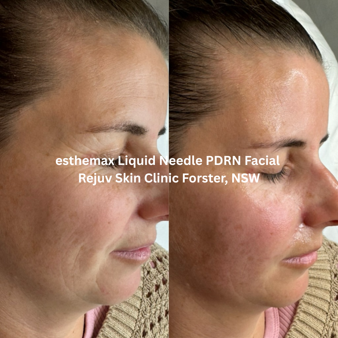 Side profile before and after results of an esthemax® Liquid Needle PDRN Facial performed at Rejuv Skin Clinic in Forster, New South Wales. Fine lines around the eye and cheek area appear softened, while skin texture looks plumper and more rejuvenated, revealing a refreshed, healthy glow.