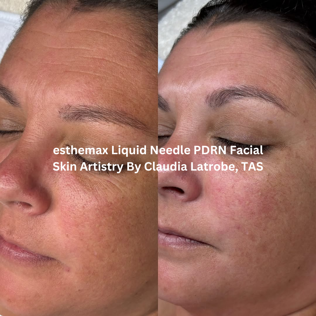 Before and after close-up images of the cheek area following an esthemax Liquid Needle PDRN Facial at Skin Artistry By Claudia in Latrobe, Tasmania. The after image shows smoother-looking skin with improved hydration, softness, and a more even complexion.