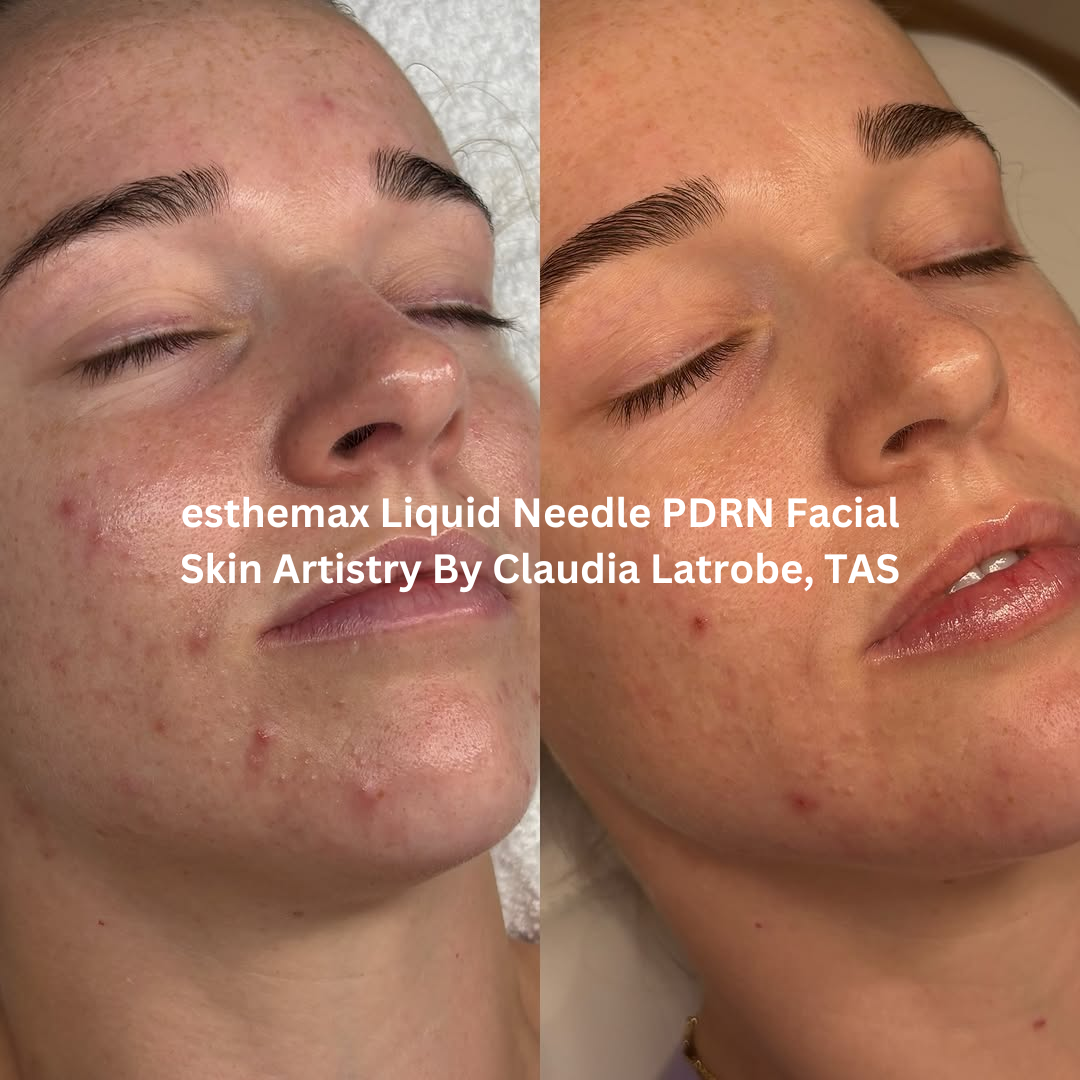 Before and after images of the skin following an esthemax Liquid Needle PDRN Facial at Skin Artistry By Claudia in Latrobe, Tasmania. The after image shows improved skin clarity, a more refined texture, and a healthier-looking glow.