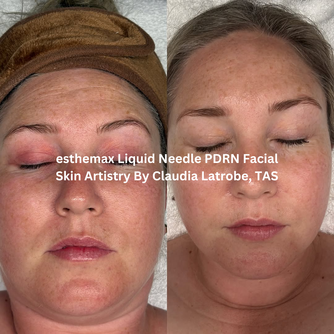Progress images taken over a few months following ongoing esthemax Liquid Needle PDRN Facial treatments at Skin Artistry By Claudia in Latrobe, Tasmania. The after image shows calmer-looking skin with improved clarity, more even tone, and a healthier overall complexion.