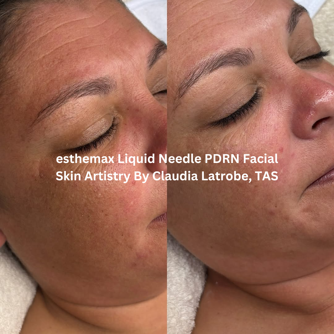 Before and after images of the cheek and mid-face following an esthemax Liquid Needle PDRN Facial at Skin Artistry By Claudia in Latrobe, Tasmania. The after image shows a more refined skin texture with visible glow and reduced appearance of uneven tone.