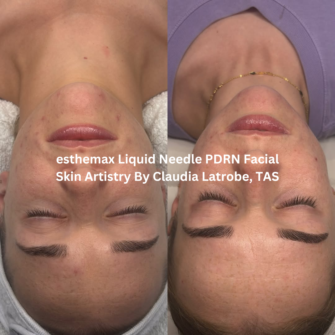 Before and after images of the face following an esthemax Liquid Needle PDRN Facial at Skin Artistry By Claudia in Latrobe, Tasmania. The after image shows visibly brighter skin with improved smoothness, enhanced radiance, and a more even-looking complexion.