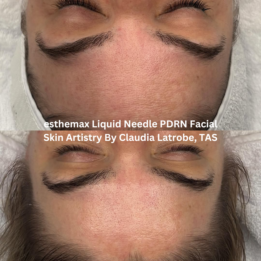 Before and after esthemax Liquid Needle PDRN Facial, showing smoother forehead texture, refined pores, and a brighter, more even complexion.