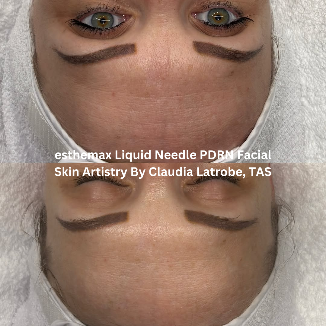 Progress images of the forehead and brow area following esthemax Liquid Needle PDRN Facial treatments at Skin Artistry By Claudia in Latrobe, Tasmania. The after image shows improved skin texture, hydration, and a reduction in the appearance of fine lines.
