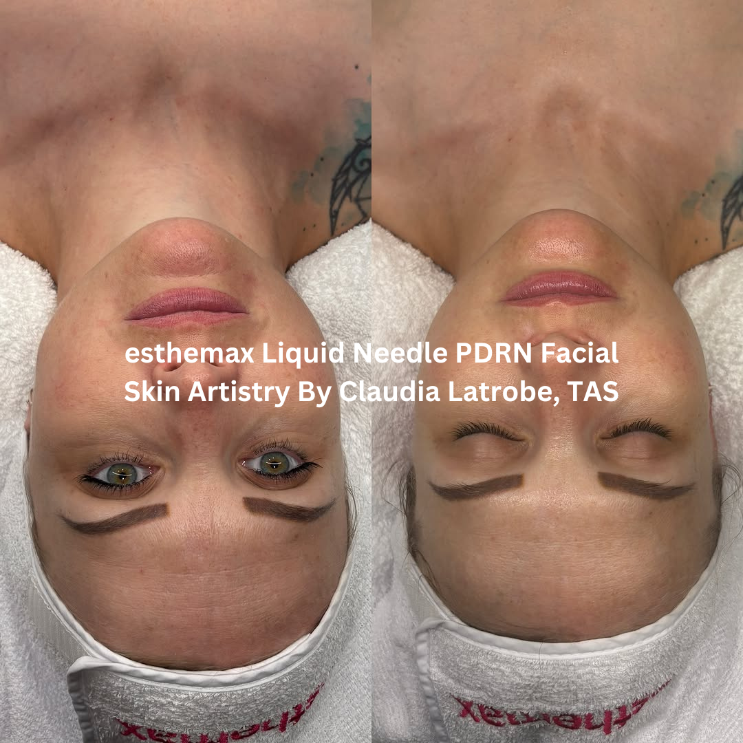 Progress images following ongoing esthemax Liquid Needle PDRN Facial treatments at Skin Artistry By Claudia in Latrobe, Tasmania. The after image shows improved skin clarity, enhanced radiance, and a more even-looking complexion.