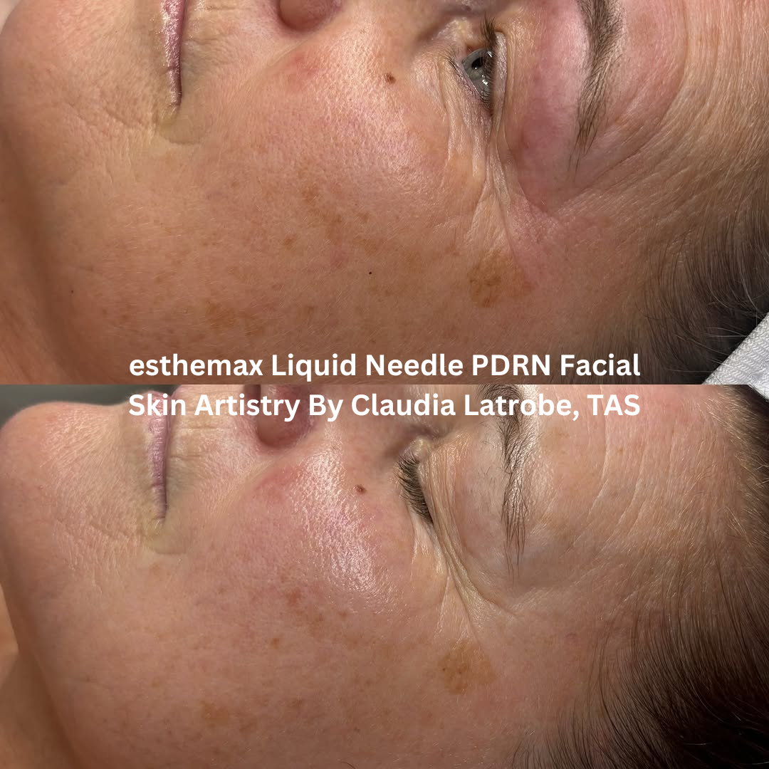 Before and after images of the skin following an esthemax Liquid Needle PDRN Facial at Skin Artistry By Claudia in Latrobe, Tasmania. The after image shows smoother-looking skin with improved radiance, hydration, and overall skin clarity.