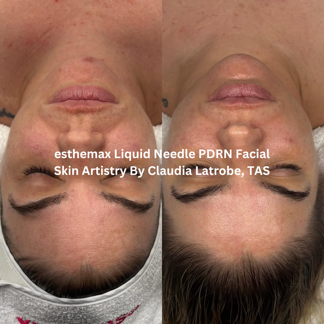 Before and after esthemax Liquid Needle PDRN Facial, highlighting improved skin clarity, refined texture, and increased radiance.