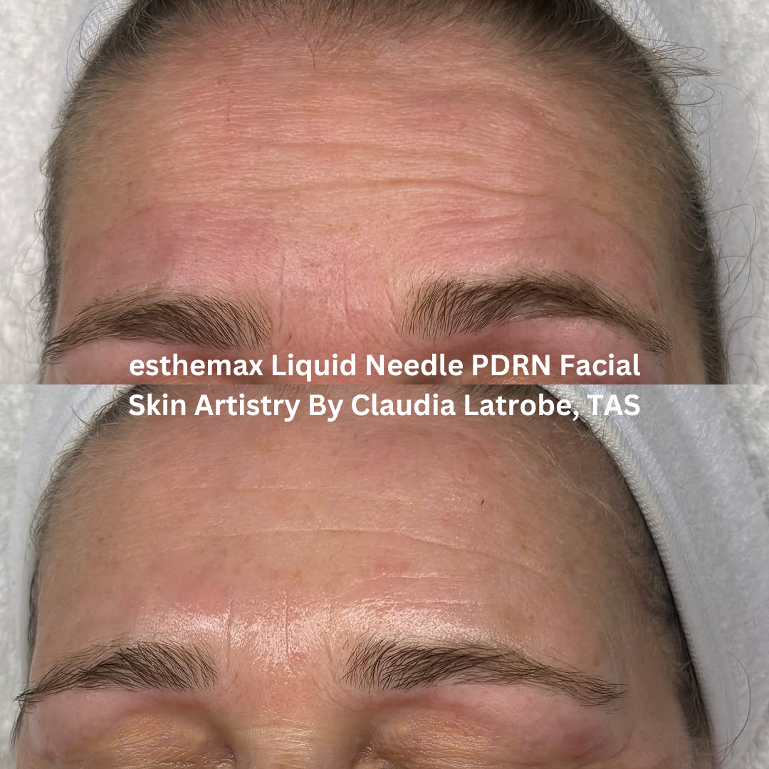 Progress images of the forehead following esthemax Liquid Needle PDRN Facial treatments at Skin Artistry By Claudia in Latrobe, Tasmania. The after image shows a visibly smoother skin surface with softened expression lines and improved luminosity.